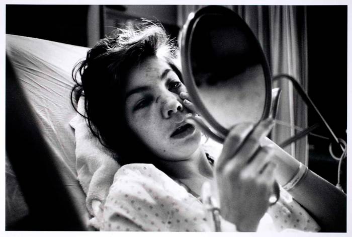 woman in hospital bed looking in handheld mirror at bruises on her face